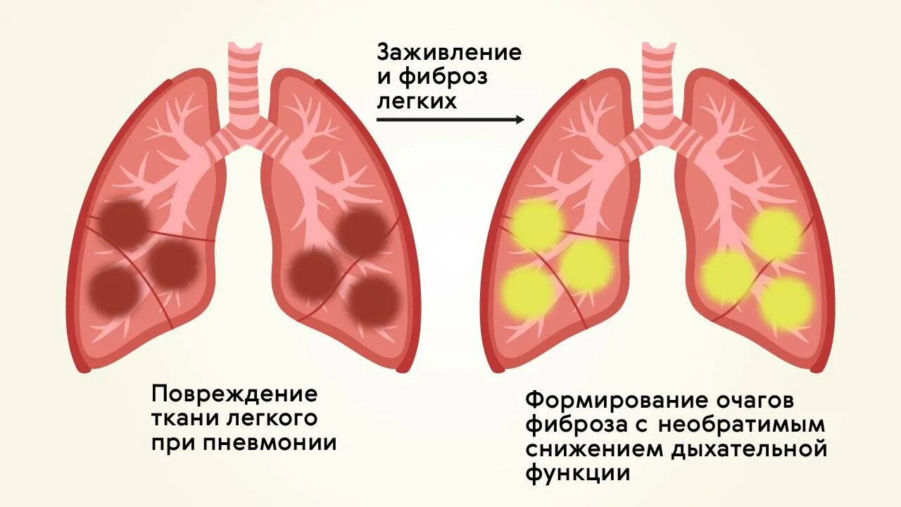 Острое поражение легких