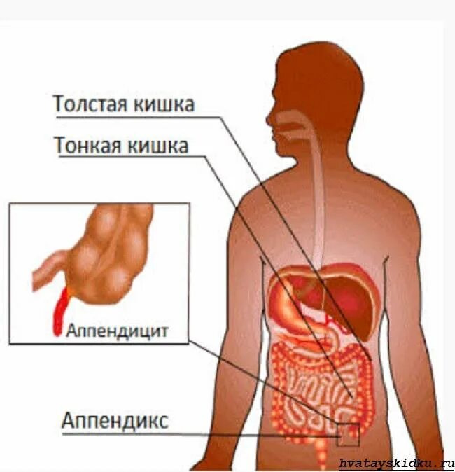 Аппендицит воспаление кишечника. Где находятсяапендецыт. Строениемкишечника аппендикс. Лапароскопическая операция аппендицит. Где находится аппендикс с какой стороны.