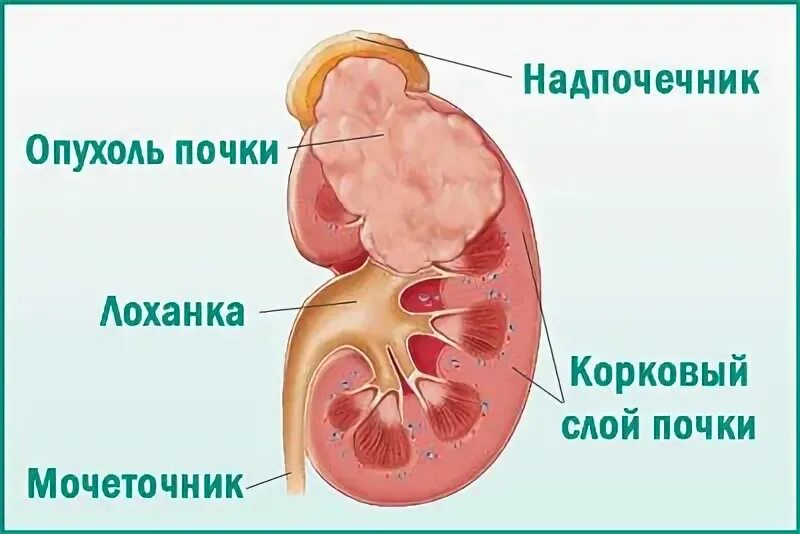 Прогноз рака почки после операции. Резекция опухоли почки. онкология почки 1 стадия.