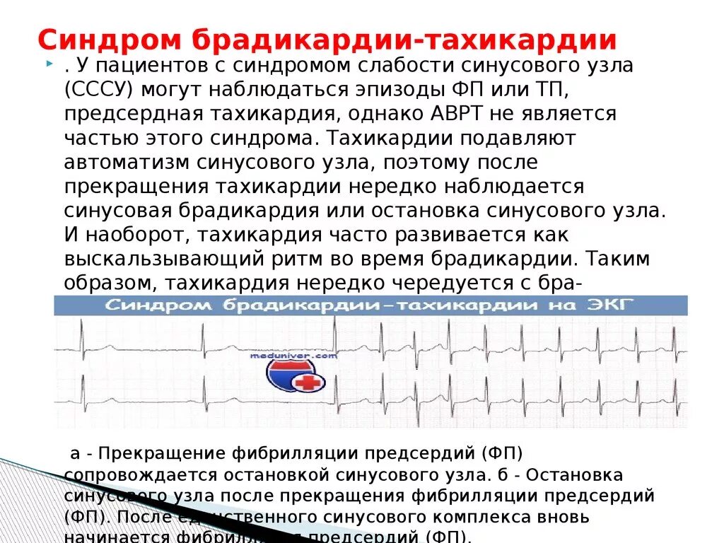 Чем отличается аритмия от тахикардии. Синдром бради-тахикардии на экг. тахикардия и брадикардия. тахикардия и брадикардия одновременно. тахикардия брадикардия аритмия.