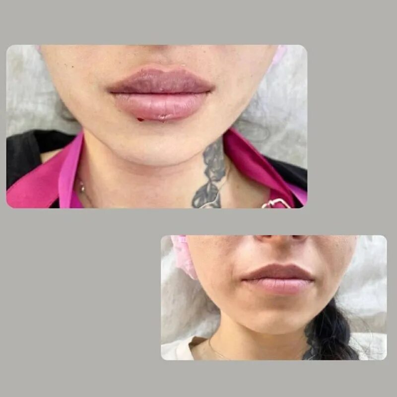 Губы гиалуроновой 1мл с 1 мл. Губы гиалуроновой кислотой. Teosyal для губ. Отек после увеличения губ по дням. Увеличение губ этапы заживления.