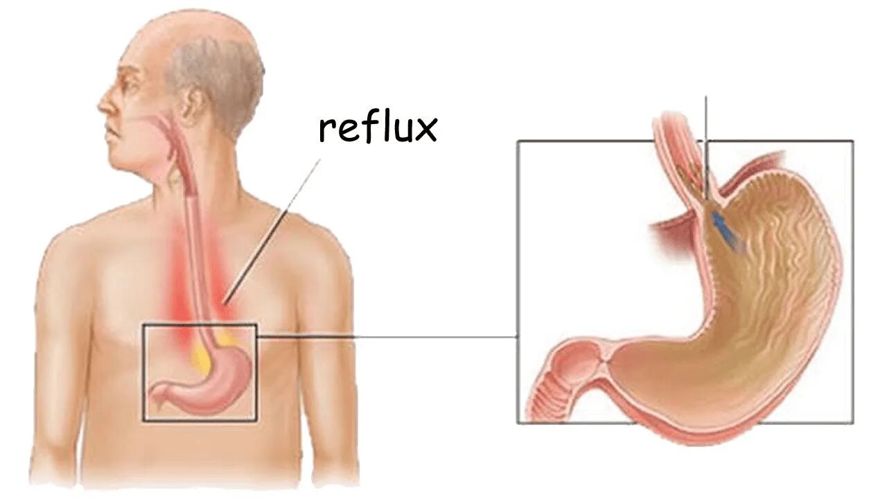 Заброс кислоты из желудка в пищевод симптомы. Рефлюкс-эзофагит изжога\. Внепищеводный рефлюкс эзофагит. Поверхностный гастрит рефлюкс эзофагит.