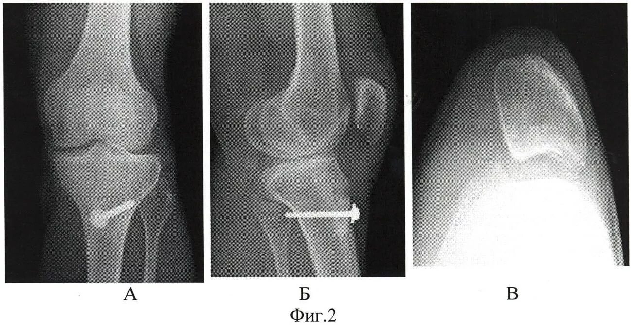 Врожденный вывих надколенника рентген. Подвывих надколенника рентген. Вертикальный вывих надколенника рентген. Вывих надколенника рентген. Перелом надколенника операции
