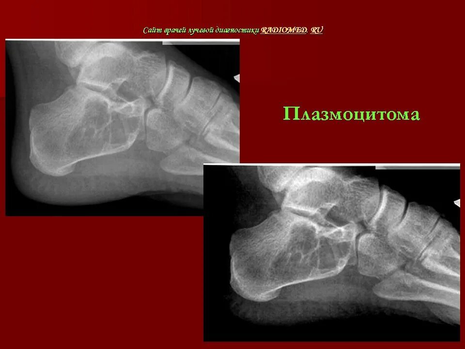 Солитарная плазмоцитома кт. Плазмоцитома экстрамедуллярная кт. Солитарная форма миеломы. Солитарная плазмоцитома. Плазмоцитома экстрамедуллярная кт.