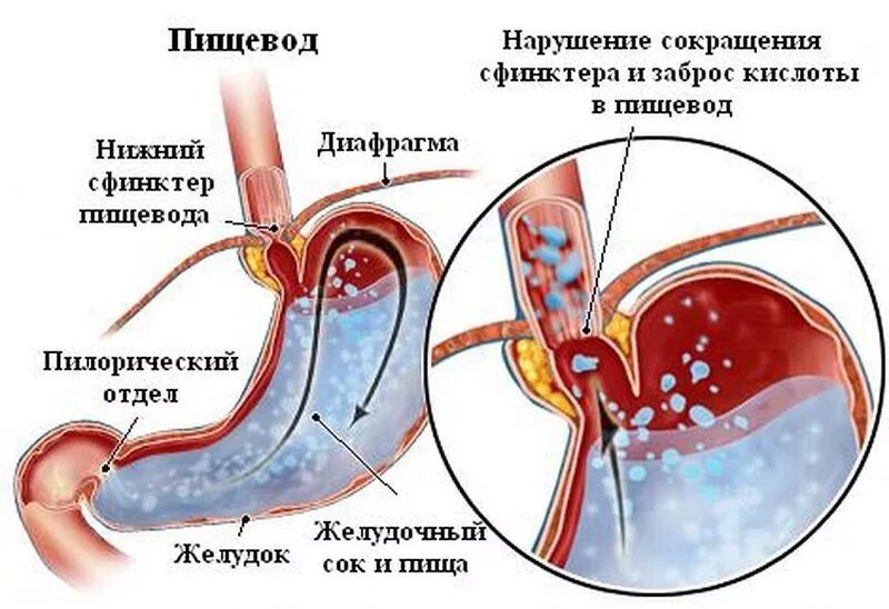 Заброс кислоты из желудка в пищевод симптомы