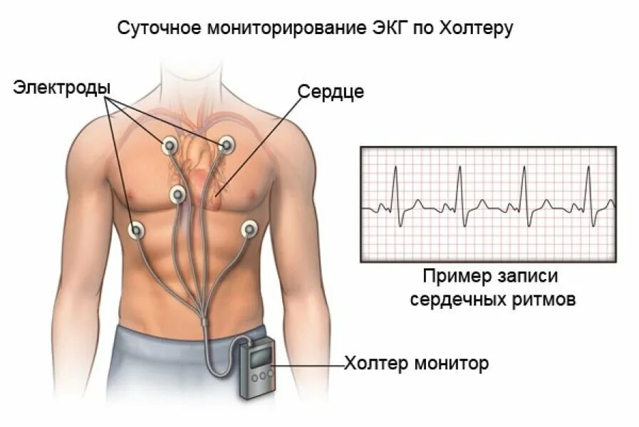 Как делается холтер. Наложение электродов холтер. холтер схема установки электродов. 12 канальный холтер схема наложения электродов. суточное мониторирование экг схема наложения электродов.