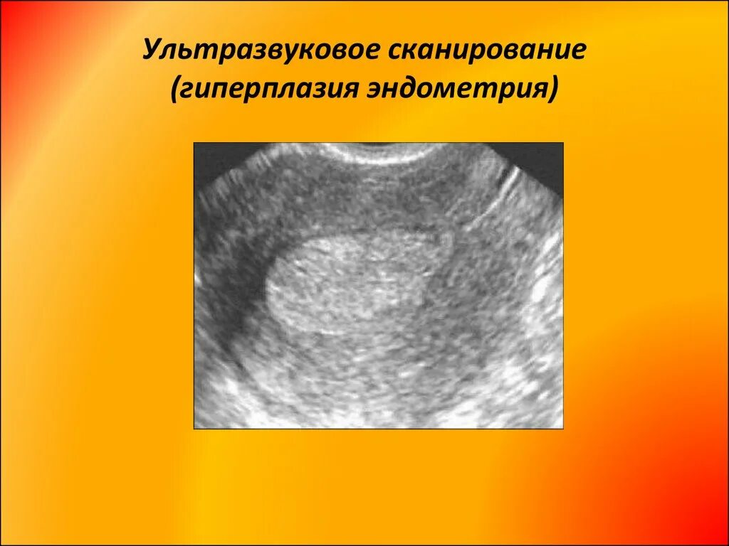 Гиперплазия эндометрия МФЯ. Железистая гиперплазия эндометрия УЗИ. Гиперплазия эндометрия УЗИ критерии. Атипическая гиперплазия эндометрия УЗИ.