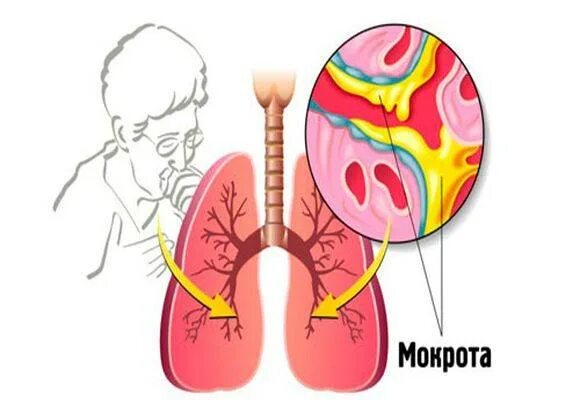 Кашель с обильным выделением мокроты. Мокрый кашель с мокротой. Мокрота в дыхательных путях. Влажный кашель с мокротой.