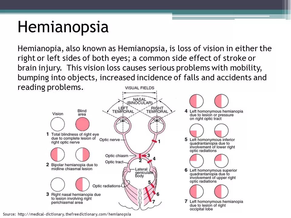 Битемпоральная гемианопсия. Квадрантная гомонимная гемианопсия. Правосторонняя гомонимная гемианопсия. Левосторонняя гомонимная гемианопсия. Монимен