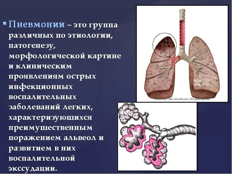 Сообщение на тему воспаление лёгких. Инфекционные заболевания легких. Заболевание легких пневмония. Заразные заболевания легких