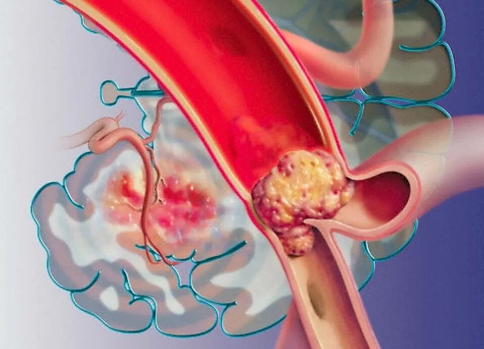 Закупорка головных сосудов