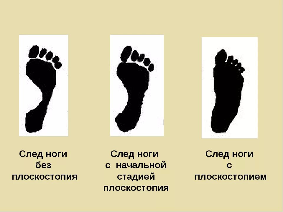 Средняя стопа. Отпечаток стопы 3 степени плоскостопия. Нормальный отпечаток стопы без плоскостопия. Стобе без плоскостопия. След ноги без плоскостопия.