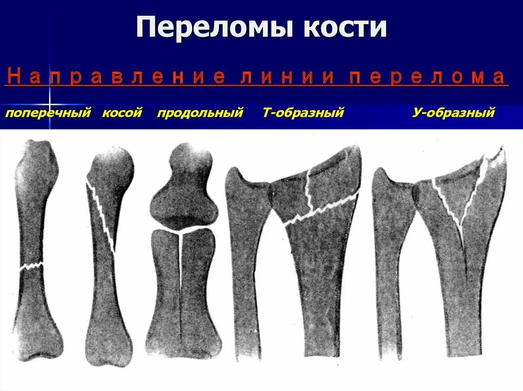 Разрыв кости. Поперечные продольные косые винтообразные оскольчатые переломы. Классификация переломов плоских костей. Поперечный перелом кости. Поперечные переломы костей.