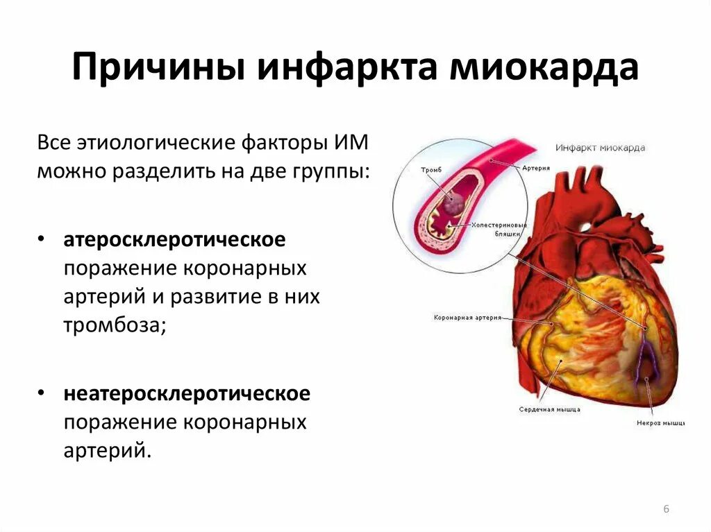 Инфаркт миокарда причины развития заболевания. Механизм развития стенокардии и инфаркт миокарда. Причины заболевания инфаркта миокарда. Симптомы ИБС инфаркт миокарда.