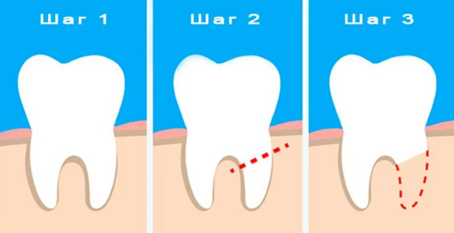Зубосохраняющая операция. Гемисекция и ампутация корня зуба. Резекция ампутация гемисекция. Гемисекция резекция зуба. Гемисекция этапы операции.