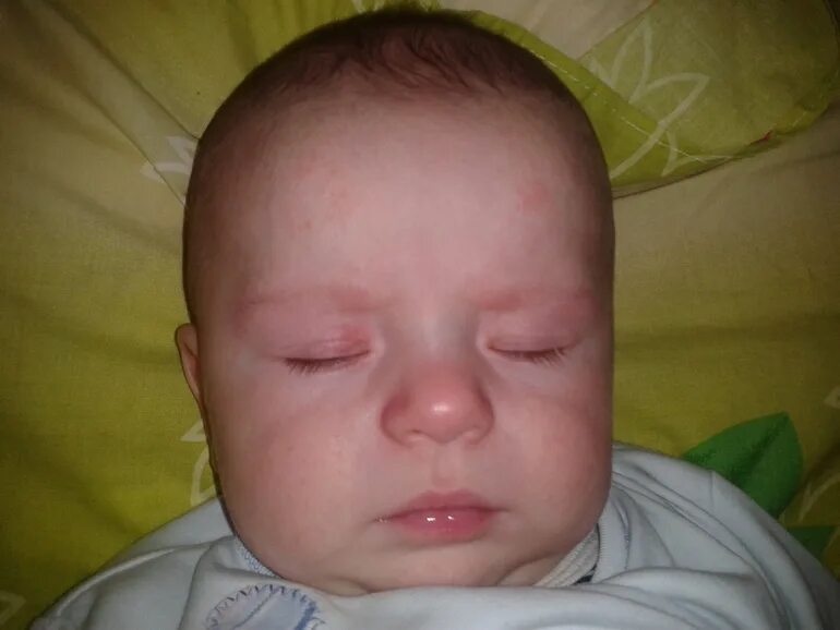 Baby Rashes: Types, Symptoms & More