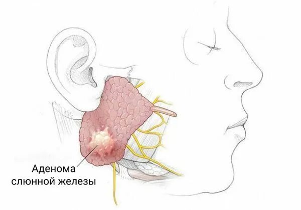 Плеоморфная аденома слюнных желез. Аденома околоушной слюнной железы. Аденома околоушной железы гистология. Аденома поднижнечелюстной слюнной железы. Операции околоушная железа