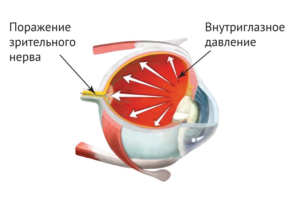 Может ли внутриглазное давление. Внутре глащное давление. Внутриглазное давление. Внутре глазное давление. Высокое внутриглазное давление.