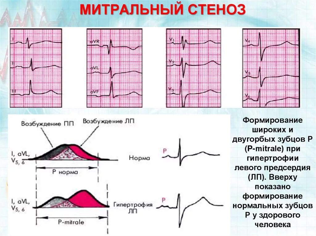 Осложнения стеноза