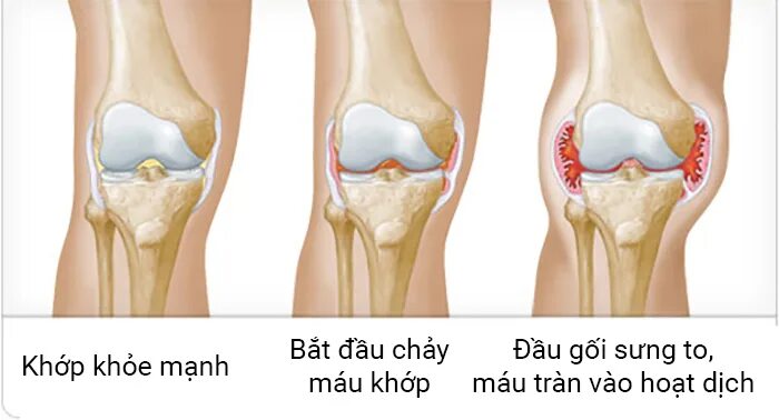 Кровотечение в коленный сустав. Гемофилия кровоизлияния. Кровоизлияние в коленный сустав.