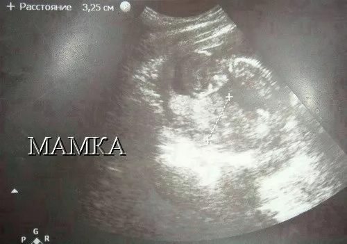 Узи 6 недель беременности гипертонус. Гипертонус матки при беременности на узи. Гипертонус матки при беременности 2 триместр узи. Гипертонус матки на ранних сроках узи. Тонус матки узи 7 недель.