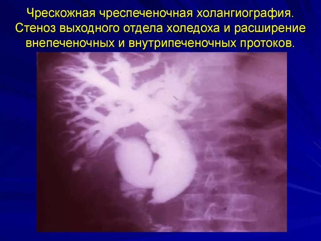 Чркзкожная чрезпеченочная холангиангиография. Чреспеченочная холангиография. Транспеченочная чрескожная холангиография. Чреспеченочная холангиография. Чрескожная чреспечёночная холангиография.