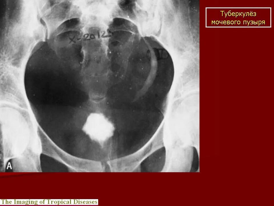 Туберкулез мочевой системы. Туберкулез мочевого пузыря кт. Туберкулёз мочевой системы. Поликавернозный нефротуберкулёз. Рентгенограмма мочевого пузыря.
