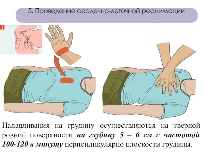 Надавливания на грудину осуществляются. Сердечно легочная реанимация надавливания на грудную клетку. ПП при остановке дыхания. Выполнение СЛР место давления на грудную клетку. Частота надавливаний при проведении реанимации составляет