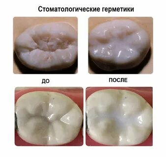 Залить зубы