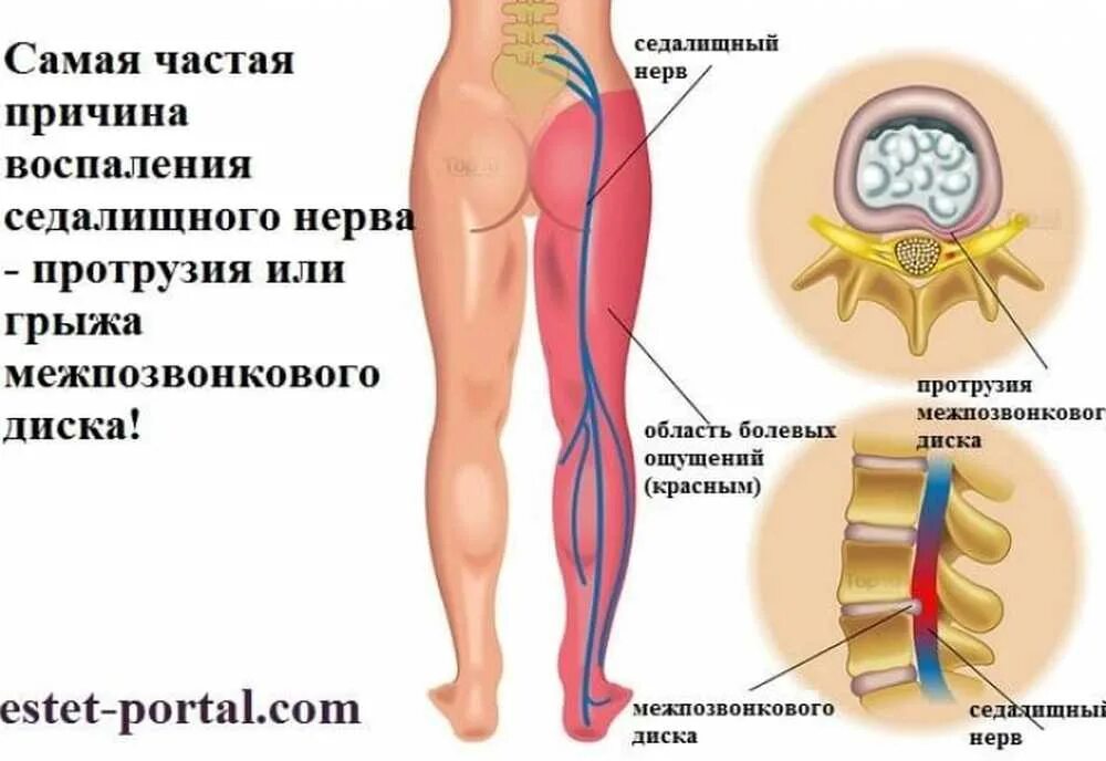 Сильные боли седалищного нерва. Синдром защемления седалищного нерва. Сидалеч седалищный нерв. Защемление седалищного нерва s1.