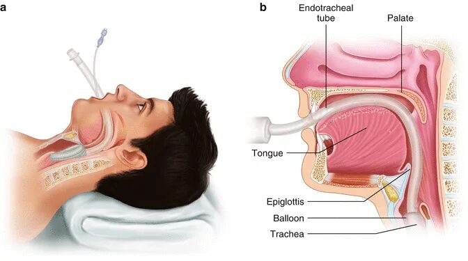 Как действует общий наркоз. Трубка во время операции