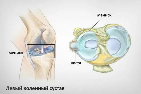 Параменисковая киста медиального мениска. Разрыв мениска коленного сустава. Параменисковая киста латерального мениска. Латеральный мениск коленного сустава разрыв.