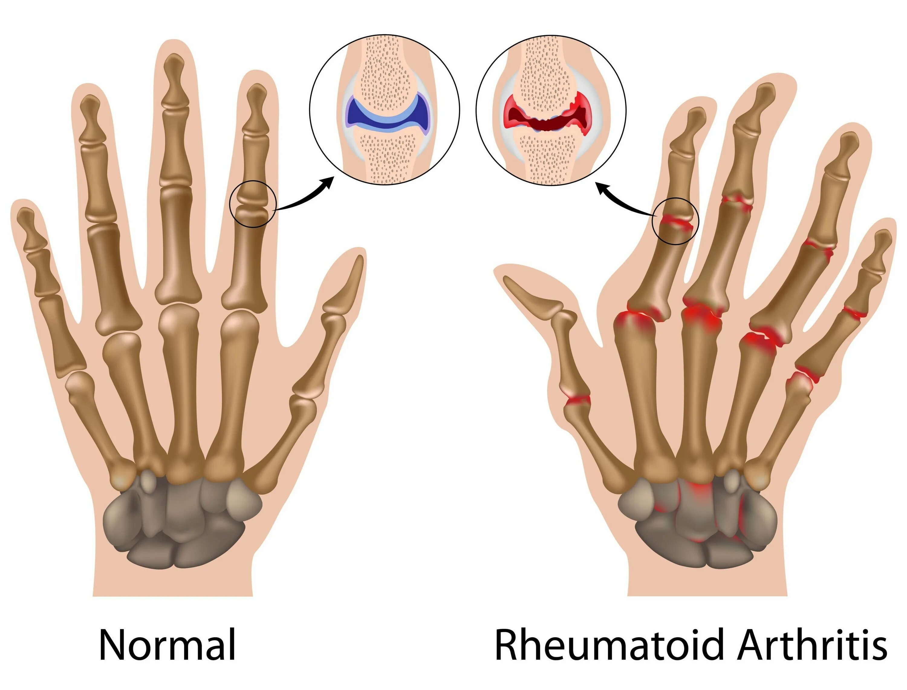 Ревматоидный артрит кистей пальцев рук. Ревматоидный артрит межфаланговых суставов. Полиартрит фаланги пальцев. Острый ревматический полиартрит это.