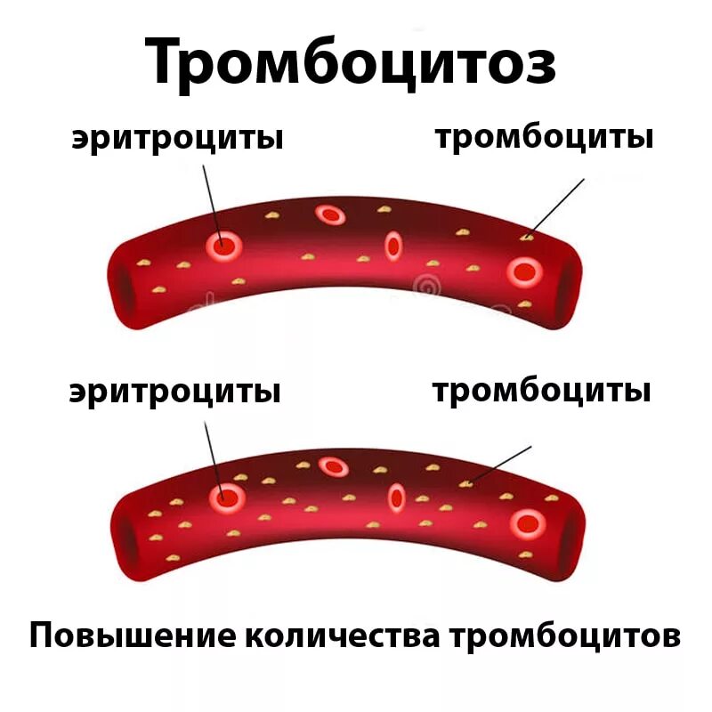 Тромбоцитах делают операцию. Тромбоцитоз. Тромбоцитоз симптомы. Тромбоцитоз проявления. Тромбоцитоз в крови.