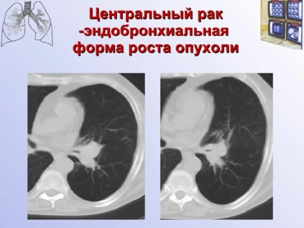 Как на кт выглядит рак