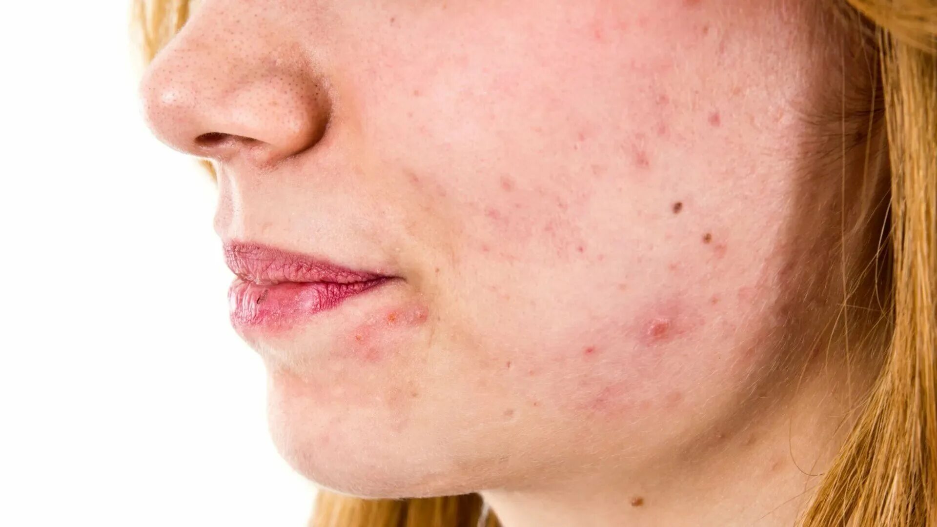 проблемная кожа есть