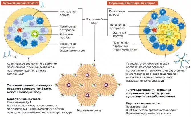 Аутоиммунная печени. Аутоиммунный гепатит патогенез схема. Первичный билиарный цирроз патогенез схема. Патогенез первичного билиарного цирроза печени. Гепатит печени механизм развития.