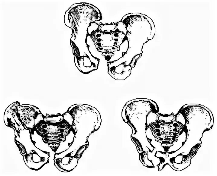 Подвздошная кость таза перелом. Кости таза лягушки. Перелом лонного сочленения. Расхождение костей лонного сочленения. Расширение таза при беременности