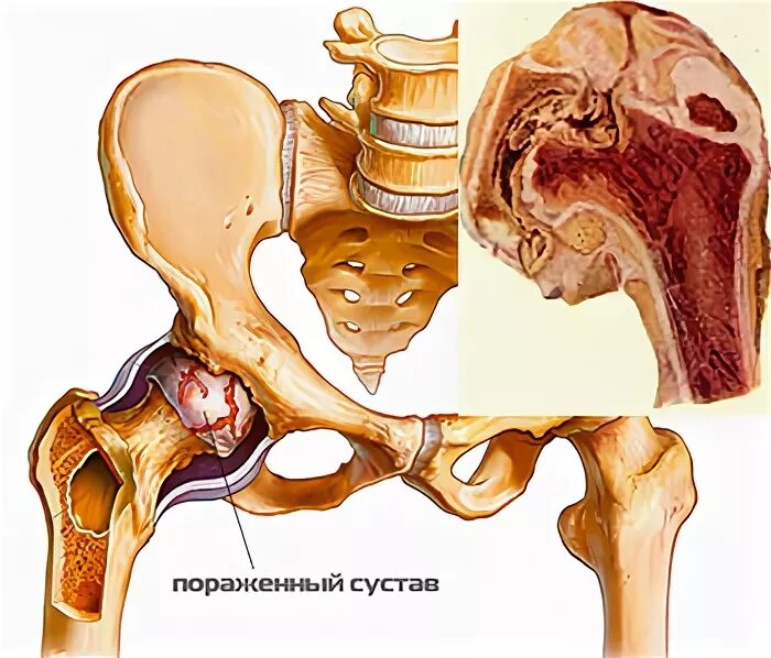 Тазобедренный артрит у ребенка. Гнойный коксит тазобедренного сустава. Реактивный коксит тазобедренного сустава. Туберкулезный коксит тазобедренного сустава.