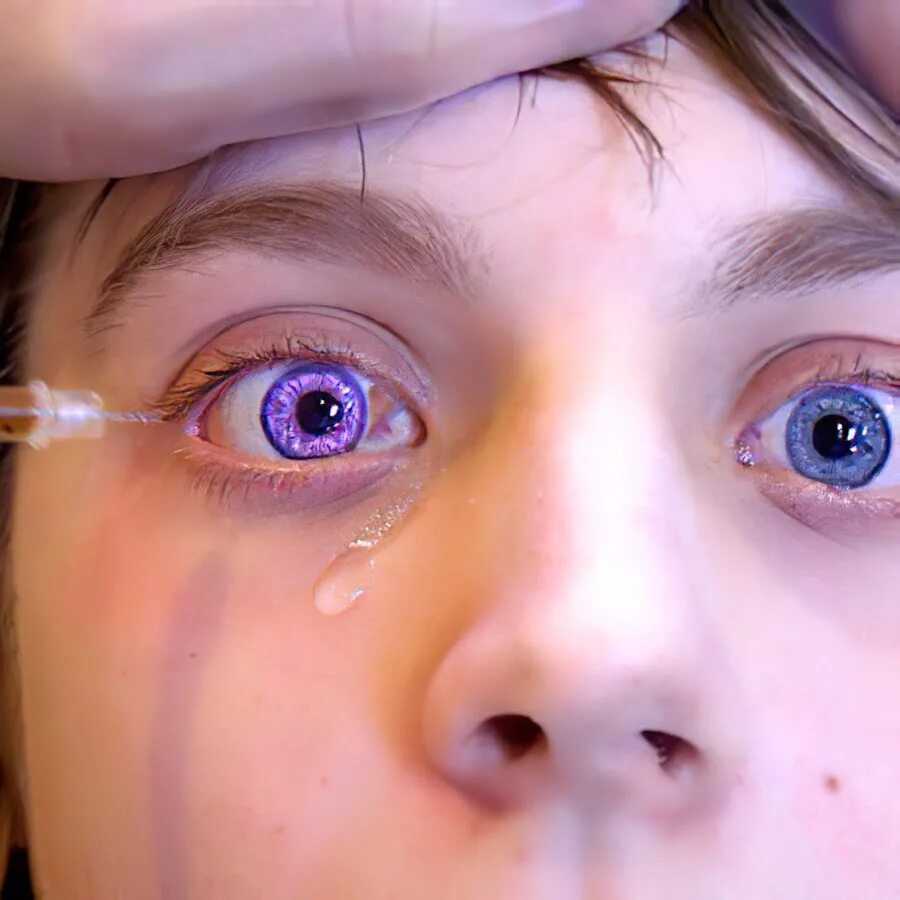 Генезис глазная. Синдром Вейля Маркезани. Генезис Александрии. Фиолетовые глаза мутация.