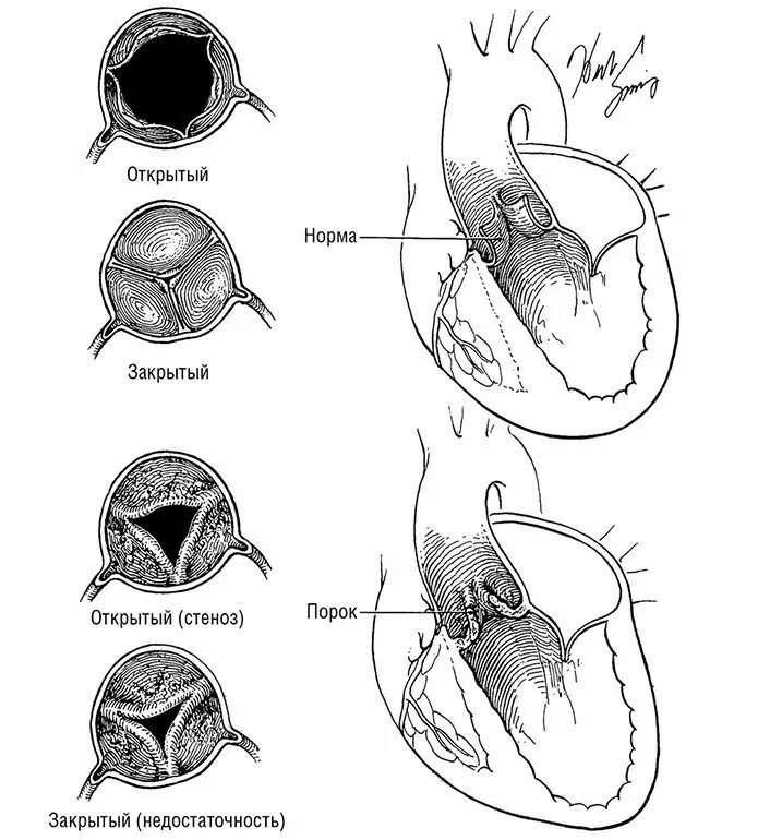 Сердечный стеноз. Митральный клапан и аортальный клапан. Аортальный клапан и митральный клапа. Порок митрального клапана сердца. Порок аортального клапана сердца.