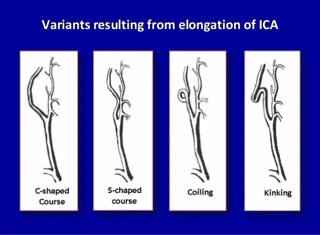 Изгиб вса. Кинкинг и койлинг. Патологическая извитость сонных артерий кинкинг. Койлинг внутренней сонной артерии. Патологическая извитость внутренней сонной артерии.