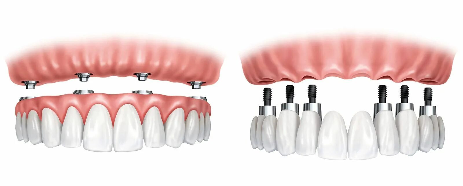 Имплантация зубов all on 6. Имплантологическая кассета Nobel полный набор для all on 4. Имплантация all on 4 челюсть. Технология имплантации зубов all-on-4.