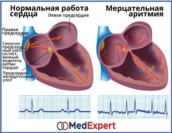 Мерцательная аритмия сердца операция