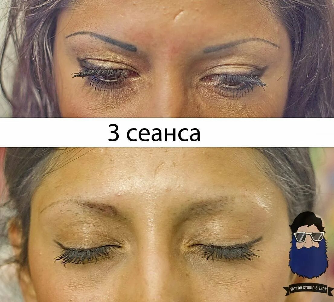 Татуаж сауна. Свести татуаж бровей. свести татуаж бровей лазером. осветление бровей лазером. цветокоррекция бровей лазером.