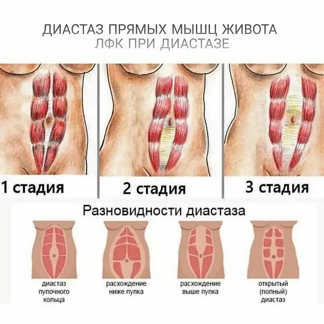 Прямая мышца живота у женщин. Расхождение мышц живота. Диастаз прямых мышц живота. Расхождение брюшных мышц.