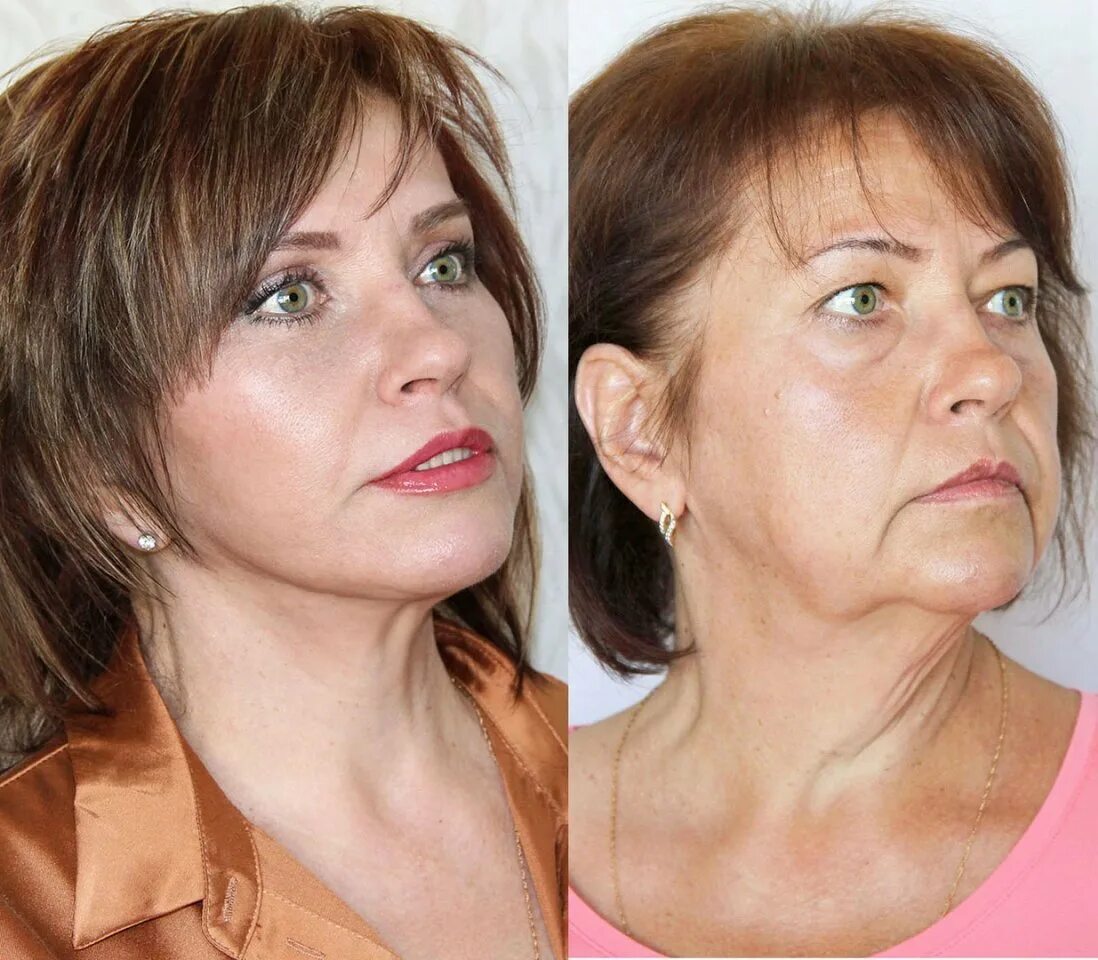 Круговая поддяжкалица. Смас лифтинг smas подтяжка лица. Операция по омоложению. Круговая биопластика лица. Пластическая операция подтяжка лица.