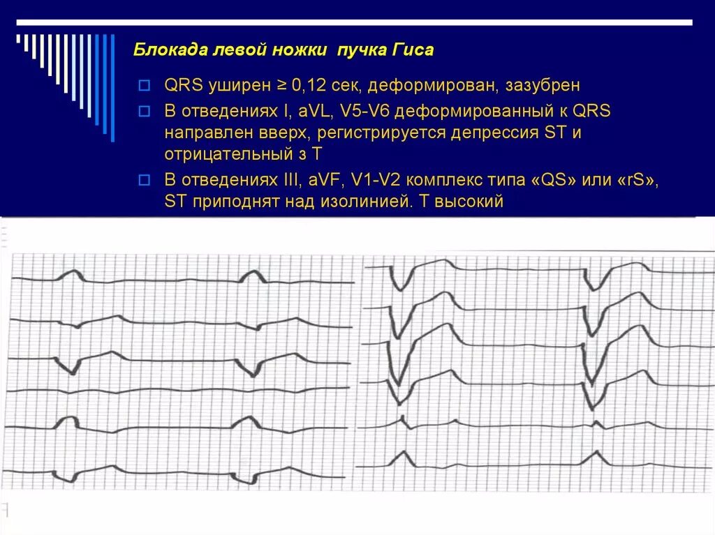 Что значит блокада левой ножки пучка гиса. Блокада левой ножки пучка Гиса на ЭКГ. Признаки блокады левой ножки пучка Гиса. Полная блокада левой ножки пучка Гиса. Блокада ЛНПГ на ЭКГ.