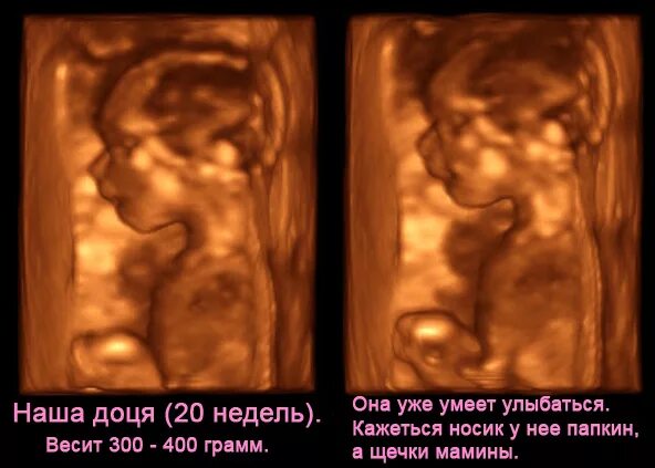 20 недель тошнота. 3д УЗИ на 20 неделе беременности. 3д 4д УЗИ 20 недель беременности.