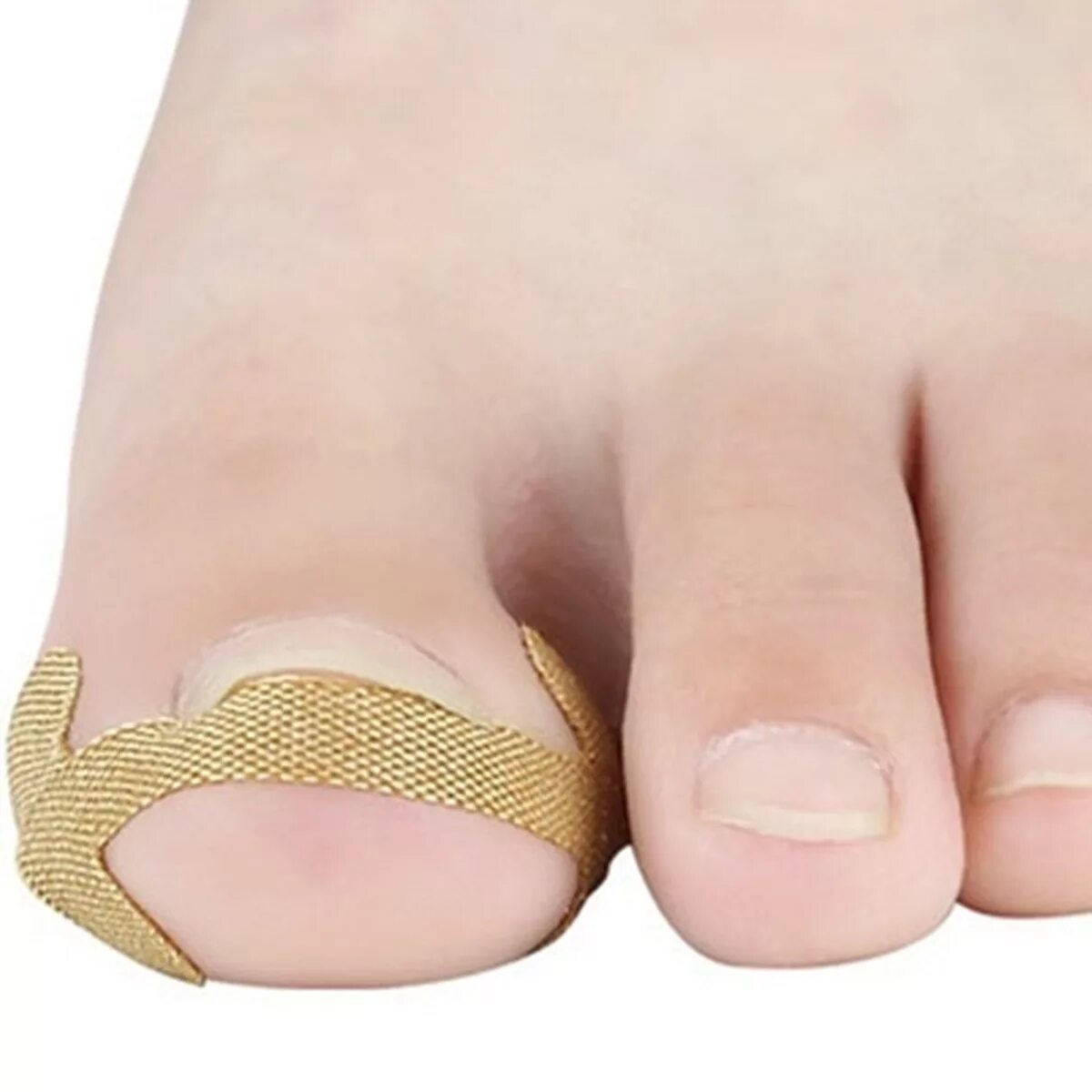 Пластырь на ноготь на ноге. Корректор вросшего ногтя. Пластыри для исправления вросших ногтей. Пластырь на ноготь на ноге. Пластырь для коррекции вросшего ногтя.